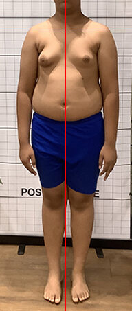 Before therapy posture