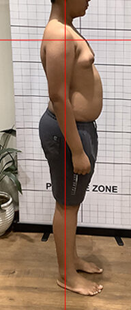 After therapy side view