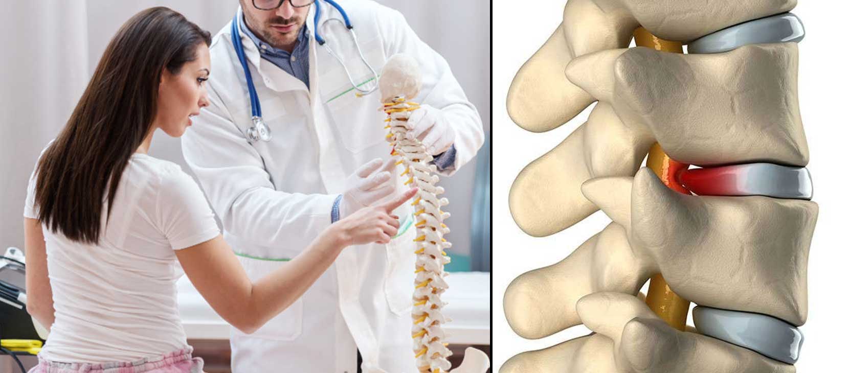 Spinal disc bulge causing back pain and nerve pressure