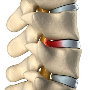 Best Clinic for Disc Bulge Pain Relief in Gurgaon